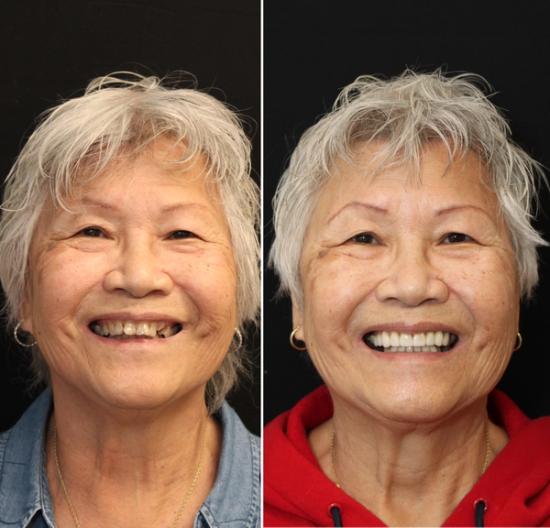 a before and after photo of an elderly woman 's smile .