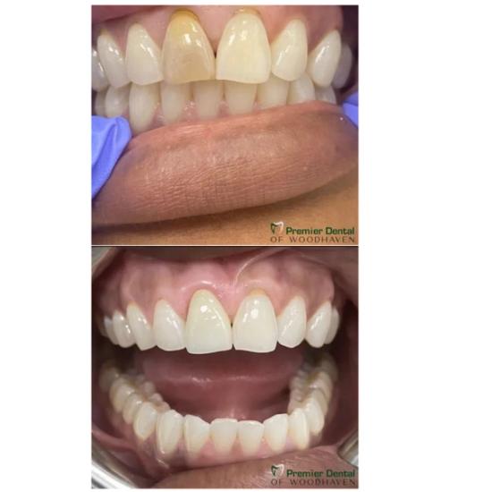 a before and after picture of a person 's teeth .