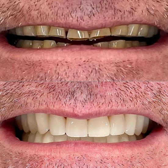 a before and after picture of a man 's teeth .