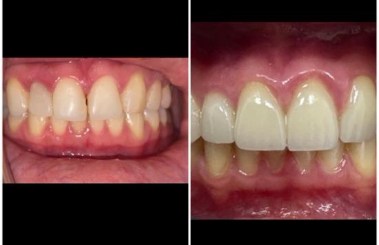 a before and after picture of a person 's teeth .