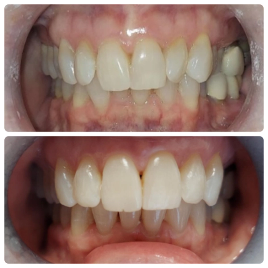 a before and after picture of a person 's teeth