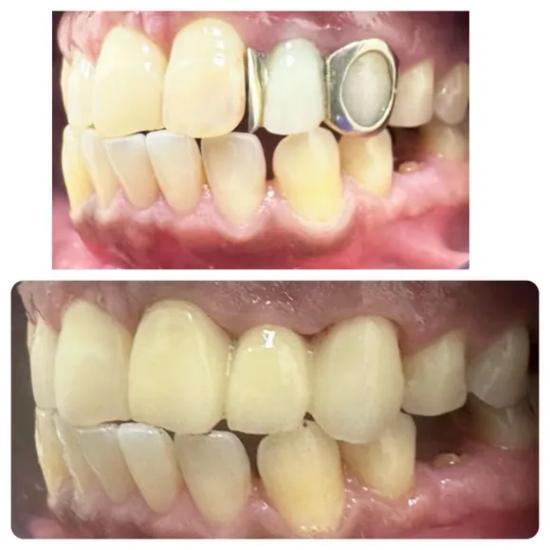 a close up of a person 's teeth before and after dental treatment .