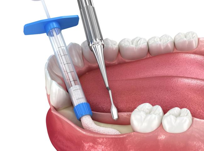 a syringe is being used to remove a tooth from a person 's mouth .