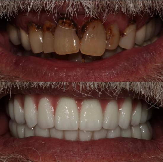 a before and after photo of a man 's teeth .