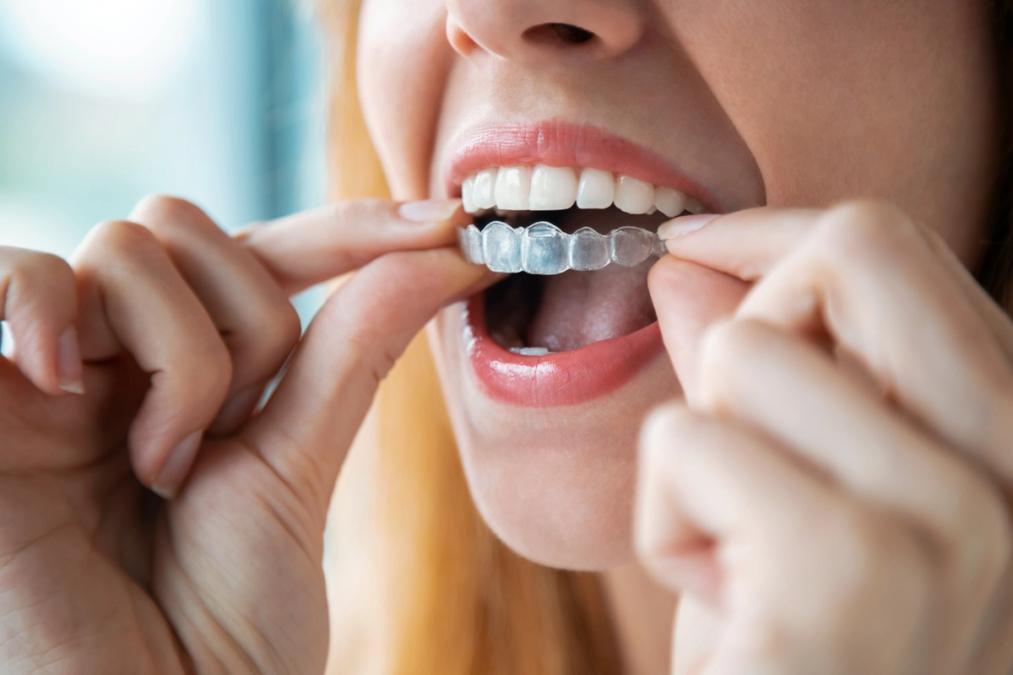 Woman inserting an Invisalign clear dental aligner into her mouth.