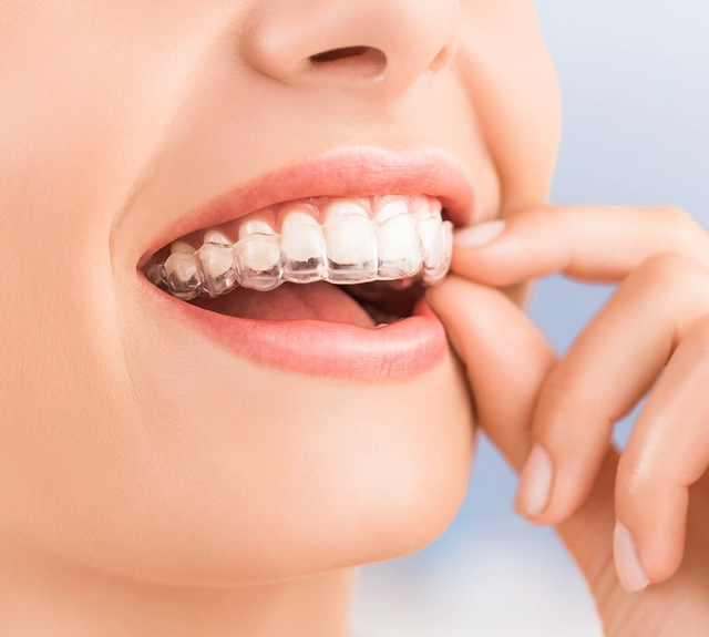 Close-up of a smiling person wearing clear dental aligners.