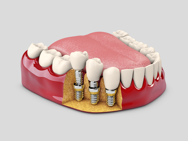 a model of a mouth with dental implants in it