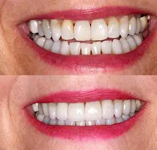 a before and after photo of a woman 's teeth .