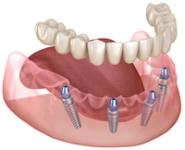 Illustration of a lower jaw with four dental implants supporting a full arch of artificial teeth.