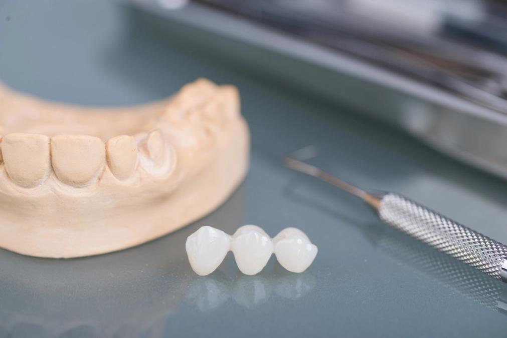 A dental model, three-unit dental bridge, and a dental explorer tool.