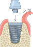 A cross-section diagram of a dental implant with the abutment being placed.
