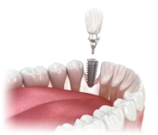 Full lower denture and an upper gum model with six dental implants.