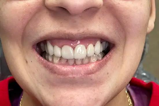 a close up of a person 's mouth with white teeth .