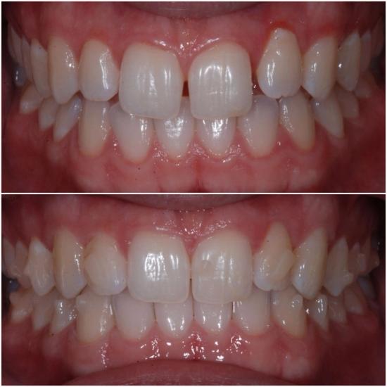 Before and after close-up of teeth showing a closed gap between front incisors and straighter alignment.