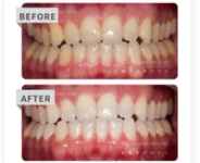 a close up of a model of a person 's teeth on a white background .