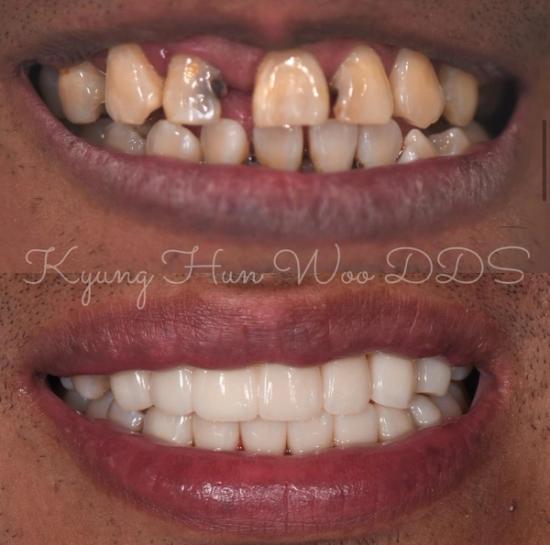 a close up of a man 's teeth before and after dental treatment .