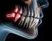 3D medical illustration of a human jaw with painful wisdom teeth highlighted in red.