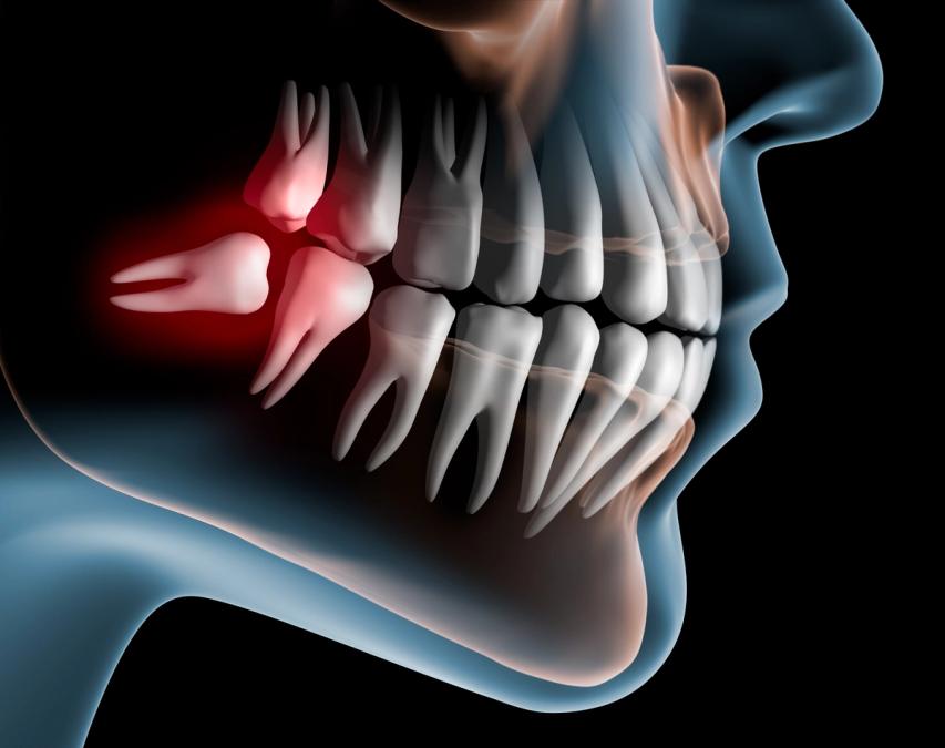 3D render of an impacted wisdom tooth highlighted in red within a translucent jaw.