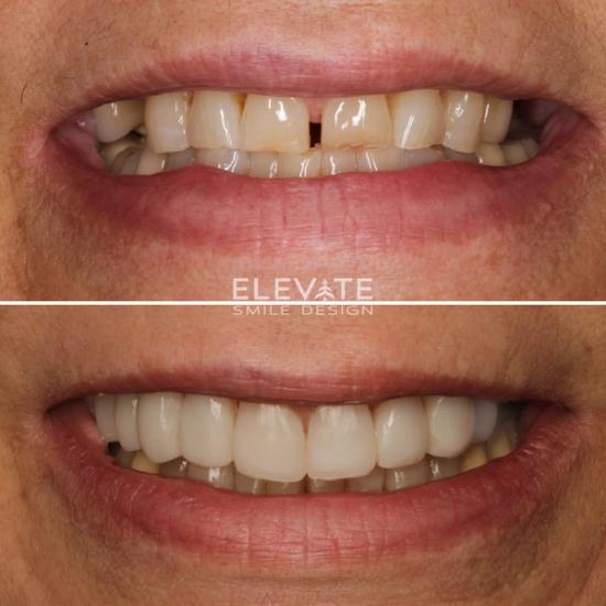 a before and after photo of a woman 's teeth .