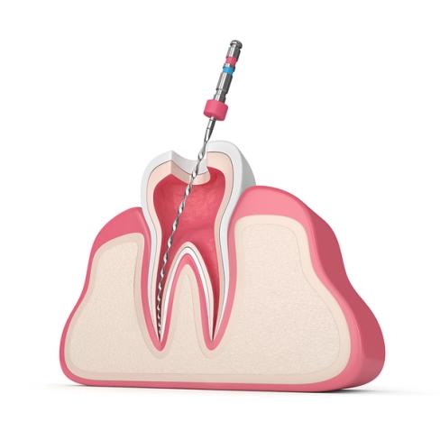 a 3d rendering of a tooth being extracted with a drill .