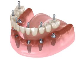 a 3d rendering of a full denture with dental implants .