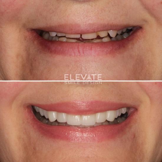 a before and after photo of a woman 's teeth .