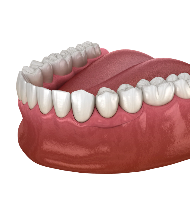 3D render of a lower jaw with a missing tooth, showing the gap in the gum line.