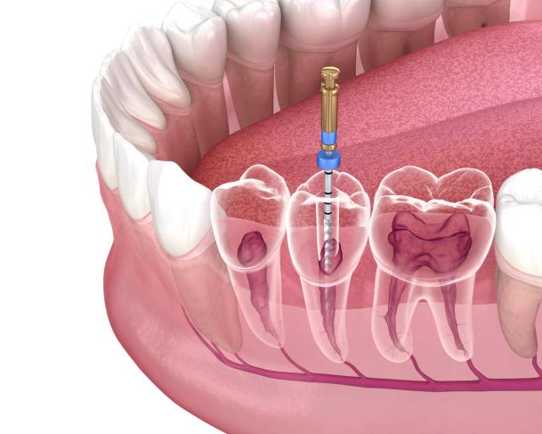 a 3d rendering of a tooth being extracted with a dental drill .