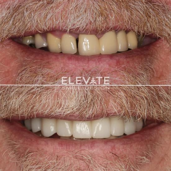 a man with a beard has a before and after picture of his teeth .
