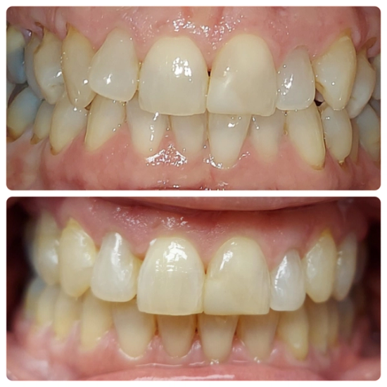 a before and after picture of a person 's teeth