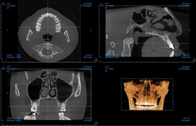 Multi-view dental CT scan showing axial, sagittal, coronal, and 3D reconstructions of the jaw and teeth.