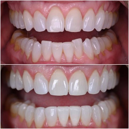 Before and after comparison of teeth, showing a transformation to whiter, more aligned teeth.