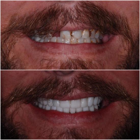 Before and after comparison of a person's mouth, showing damaged, discolored teeth above and a full set of bright white teeth below.