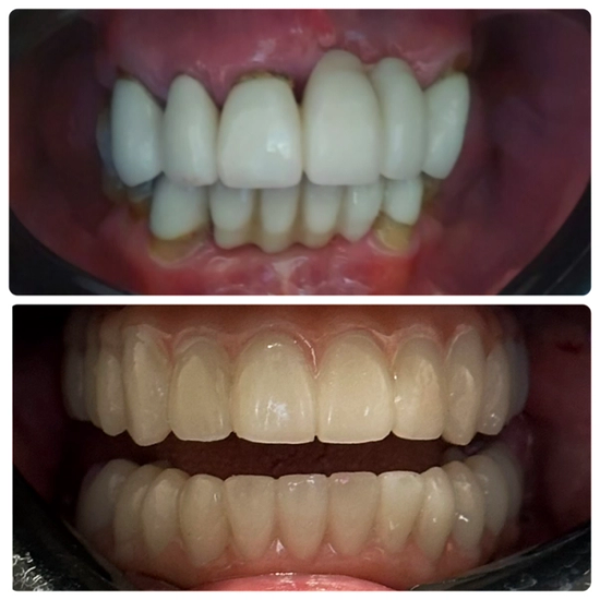 a before and after picture of a person 's teeth