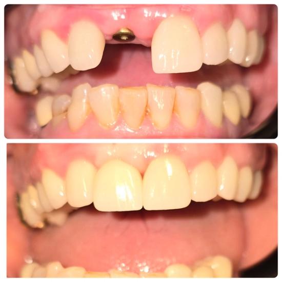 a before and after photo of a person 's teeth .