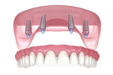All-on-4 dental implant system.