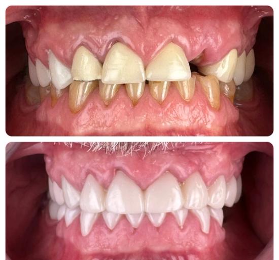 a before and after photo of a person 's teeth .
