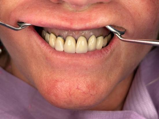 a woman is getting her teeth examined by a dentist .