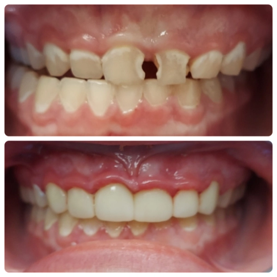 a before and after photo of a person 's teeth