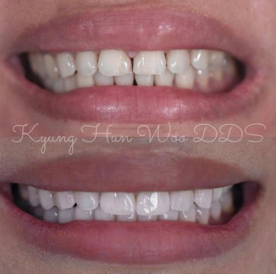 a close up of a person 's teeth with the name kyung han woo dds written on the bottom