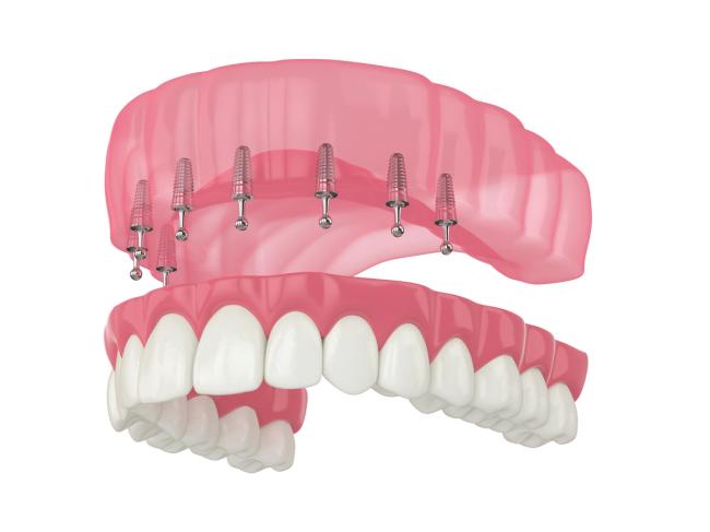 a 3d rendering of a full denture with dental implants .