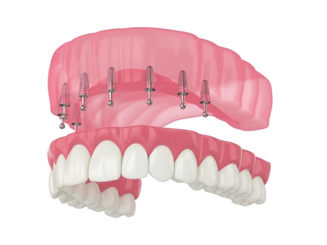 a 3d rendering of a full denture with dental implants .