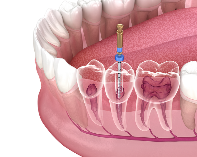 a close up of a tooth with a blue drill in it