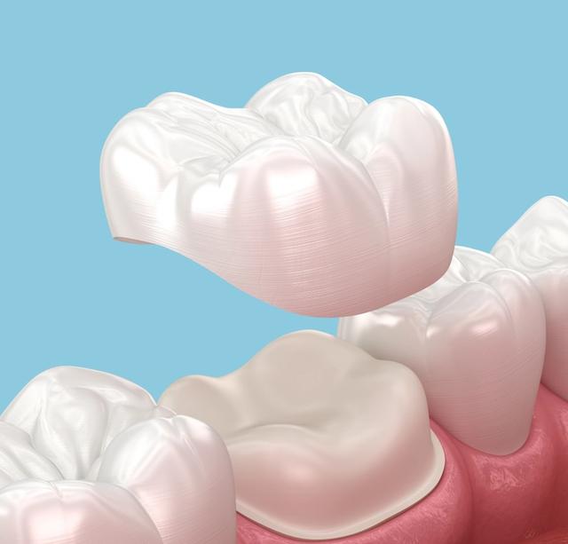 A dental crown being placed over a prepared tooth.