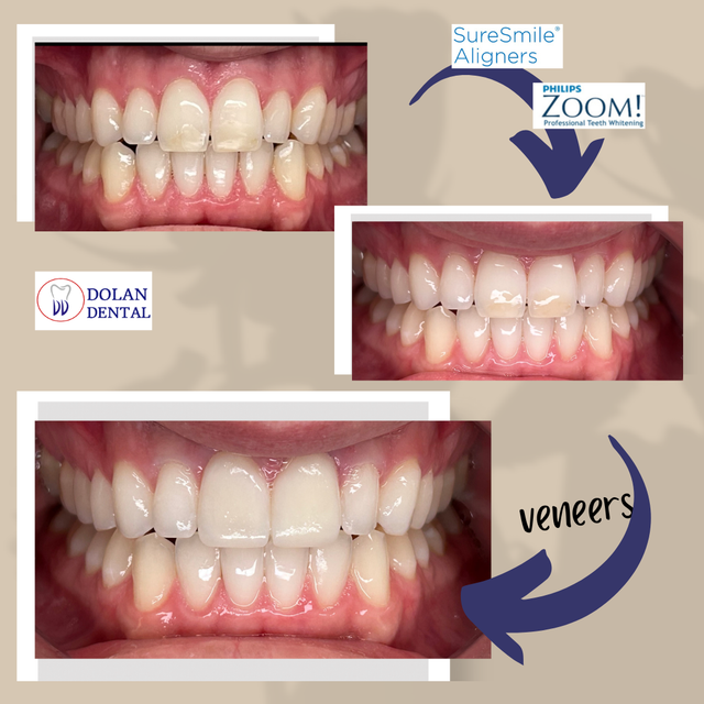 Before-and-after dental transformation showing teeth corrected with SureSmile aligners, whitened with Philips Zoom, and perfected with veneers for a bright, aligned smile.
