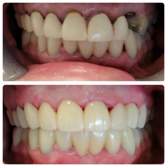 a before and after picture of a person 's teeth