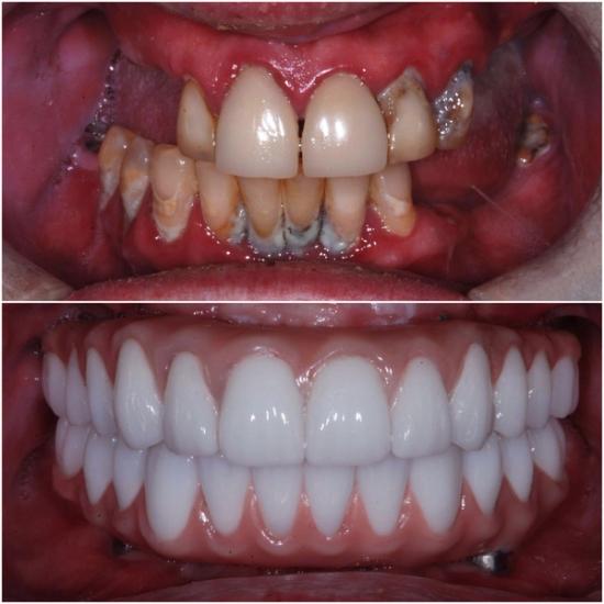 Before and after: Severely decayed teeth and inflamed gums transformed into a full set of bright white prosthetic teeth.