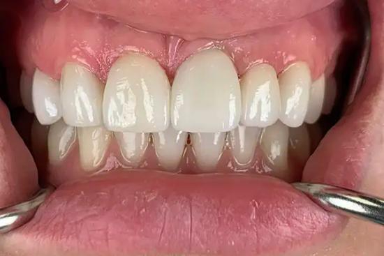 a close up of a person 's teeth with a dental mirror .