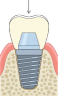 Cross-section of a dental implant showing crown, abutment, and threaded post in bone and gum.