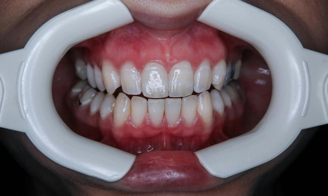a close up of a person 's teeth with a mouth guard .